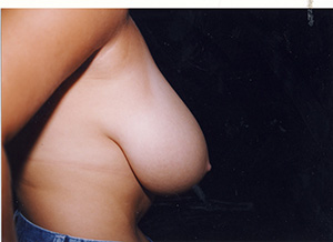 Breast Reduction 3c